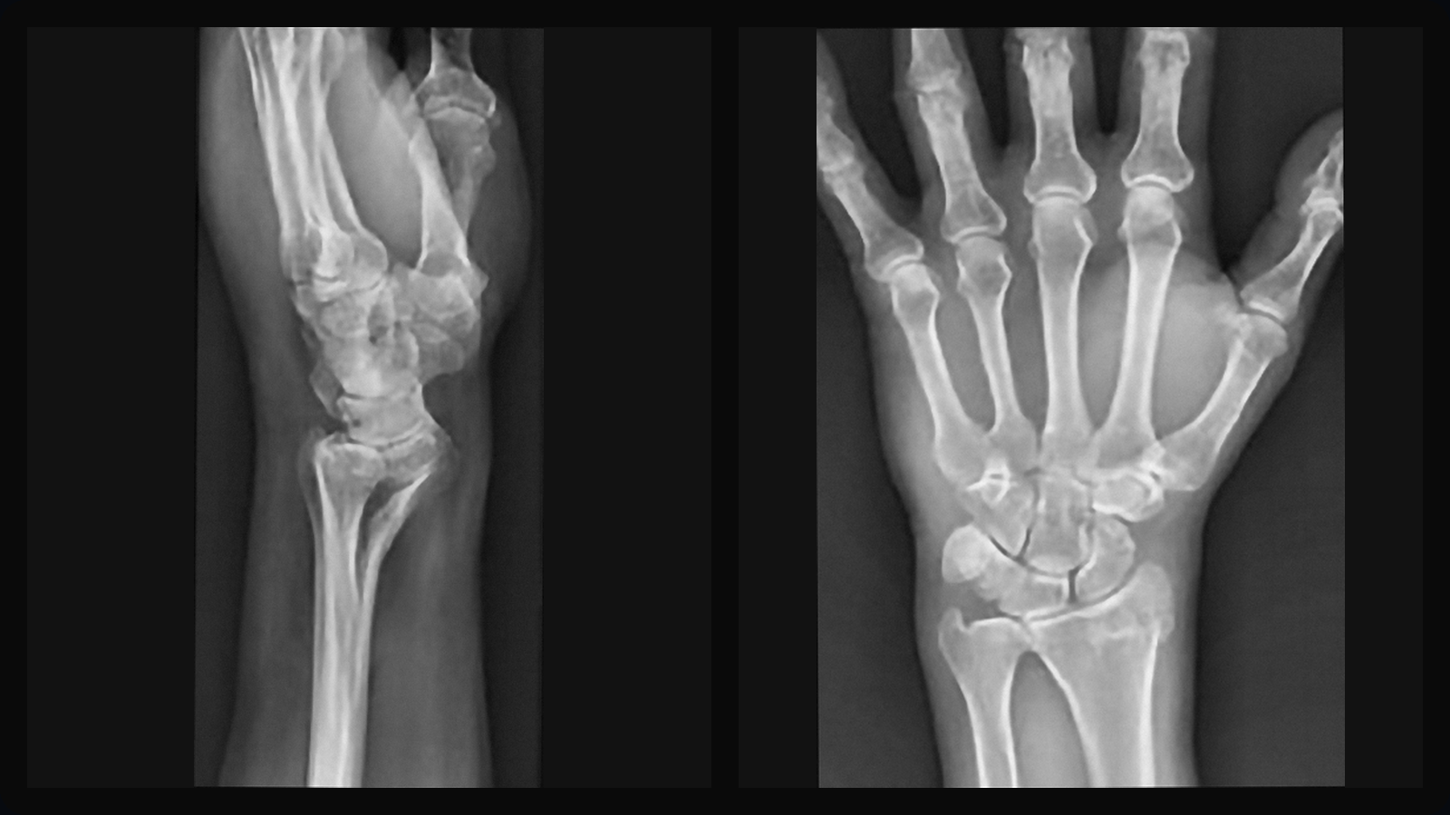 AP ve lateral el bileği grafilerinde eklem içi distal radius volar kenar kırığı